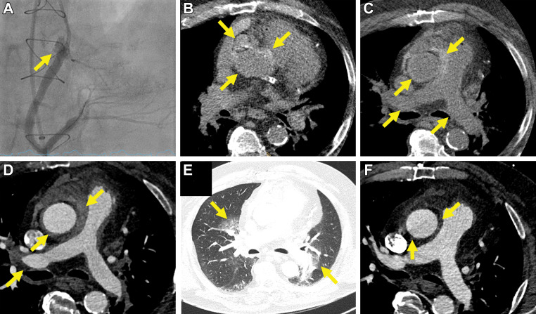 Images in a 72-year-old male patient (patient 2) undergoing coronary intervention for recanalization of a chronic total occlusion of the right coronary artery. (A) Coronary angiogram shows extravasation of contrast media recognized during the procedure (yellow arrow). The perforation was treated with immediate implantation of a covered stent. CT performed 1.5 hours after percutaneous coronary intervention showed a focal hyperattenuated layering of contrast media adjacent to the proximal right coronary artery, with additional intramural hematoma extending to the ascending aorta (Dunning III; yellow arrows on B, C, axial non–contrast-enhanced and D, contrast-enhanced CT images) and to the pulmonary arteries to the level of the lobar arteries of both lungs (yellow arrows on C, non–contrast-enhanced and D, contrast-enhanced CT images). Perivascular ground-glass opacities compatible with alveolar hemorrhage in this patient with hemoptysis were found in all pulmonary lobes, corresponding to extension of the hematoma to the alveoli (category III, according to Sueyoshi et al [13]; yellow arrows in E). Follow-up CT after 2 days revealed marked reduction of intramural hematoma of the aortic root and complete resolution of the intramural hematoma in the pulmonary trunk (yellow arrows) and lobar pulmonary arteries, along with F, a reduction of mediastinal hematoma and alveolar hemorrhage.