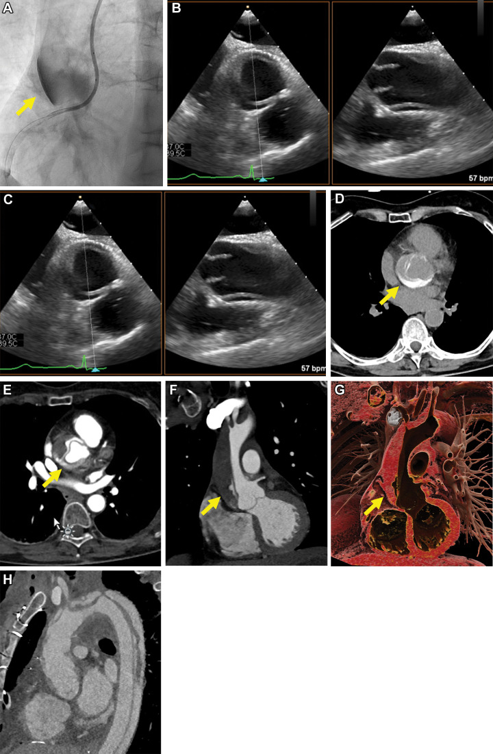 Images in a 70-year-old female patient (patient 4) undergoing recanalization of an acute-on-chronic occlusion of the right coronary artery (RCA). Following balloon predilation of the proximal to mid RCA, extravasation of contrast media in the wall of the ascending aorta occurred (yellow arrow in A). (B, C) Emergency transthoracic echocardiography showed dissection of the ascending aorta. CT performed 30 minutes after percutaneous coronary intervention helped confirm a Stanford type A acute aortic dissection, extending to the origin of an arteria lusoria (Dunning III), with partial layering of hyperattenuated contrast media from the intervention in the aortic root (yellow arrow in D–G). (H) Follow-up CT performed 12 hours after the intervention and after emergency replacement of the ascending aorta and aortic arch showed progression of the dissection to the descending aorta.