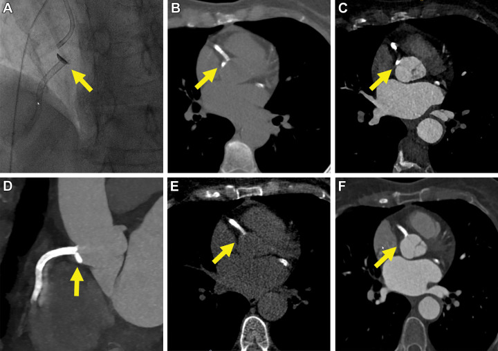 Images in a 72-year-old female patient (patient 3) undergoing intervention for recanalization of a subtotal (99%) in-stent restenosis of the right coronary artery (RCA). There was focal extravasation of contrast media at the RCA ostium (yellow arrow in A). The extravasation was immediately treated with stent extension to the RCA ostium. Thirty minutes after the intervention, CT demonstrated a small, focal, crescent-shaped hyperattenuation of the aortic wall adjacent to the RCA ostium, compatible with subintimal contrast media staining (Dunning I; yellow arrow on B, axial and C, contrast-enhanced CT images and D, multiplanar reformation of contrast-enhanced CT images). Follow-up CT after 24 hours showed complete resolution of the undiluted contrast media accumulation (yellow arrow on E, axial non–contrast-enhanced and F, contrast-enhanced CT images).