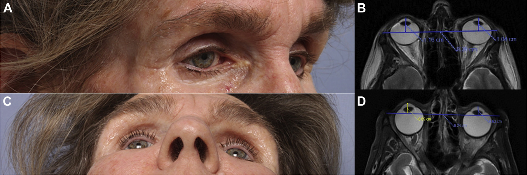 Pembrolizumab-Related Enophthalmos