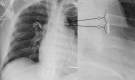 (A) Frontal chest radiograph depicts a well-positioned femoral-approach
dual-density distal tip marker within the descending aorta. (B) The magnified
insert accentuates the relatively lucent distalmost portion of the catheter
marker and the adjacent, more proximal dense portion of the marker. From a
femoral approach, if these portions of the marker were reversed, with the denser
portion located cranial to the less dense portion, the catheter would be
positioned in the ascending aorta. Knowledge of this dual-density distal marker
is often helpful, as is later shown in Figure 14.