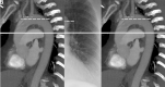(A) Frontal radiograph and (B) oblique sagittal slab maximum intensity
projection CT image reconstruction demonstrate the relationship of the carina
with the aortic knob. The descending aorta is to the right of the CT image. In
both images, the carina lies at the level of the solid white line. A level
measured 1 cm below the top of the aortic knob is indicated by the dashed white
line. The intra-aortic balloon pump tip and its marker should project between
these two levels. Also marked on both images is the origin of the left
subclavian artery (white arrowhead) nearest the top of the arch.