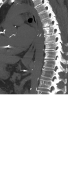 Images in a 61-year-old man measuring 183 cm in height. (A) Frontal
radiograph centered on the diaphragm to include both the distal (solid white
circle) and proximal (white dashed circle) markers of a femoral-approach
catheter that measured 258 mm in length. The distal marker is appropriately
positioned, with the proximal marker projecting over the superior aspect of the
L2 vertebral body. (B) Sagittal slab maximum intensity projection reconstruction
image obtained just before catheter placement demonstrates the relationship of
the celiac (white arrow) and superior mesenteric artery (white arrowhead)
origins relative to the L1 and L2 vertebral bodies.