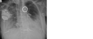 (A) Frontal chest radiograph demonstrates how the diminutive intra-aortic
balloon pump (IABP) marker is often hard to resolve from the neighboring
coronary bypass graft clips and other objects. (B) Same image with the IABP
marker in the white circle.