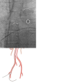 (A) Femoral-approach positioning of an intra-aortic balloon pump catheter
on a bedside frontal chest radiograph, with single distal marker (in white
circle) projecting approximately 1 cm below the top of the aortic knob (dashed
white curve). The carina is also marked with the dashed white angle. (B) Diagram
demonstrates the layout of the catheter placed by a femoral approach. (Fig 2B
used with permission of Mayo Foundation for Medical Education and Research, all
rights reserved.) (C) Fluoroscopic overhead image of the distal marker at time
of placement by the interventionalist, showing the distal marker (in white
circle), top of the aortic arch (dashed white curve), and the carina (dashed
white angle).