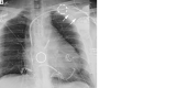 Images in a 44-year-old man with heart failure. (A) Initial frontal chest
radiograph demonstrates the proximal marker from an axillary-placed intra-aortic
balloon pump (IABP) catheter (dashed white circle), originally thought to be a
clip. This presumed “clip” projects above the aortic arch. The
presence of an IABP catheter was not recognized by multiple radiologists for
several days, even after more proximal migration of the proximal marker into the
left axillary artery on (B) the follow-up radiograph. On close inspection, the
follow-up radiograph demonstrates a high distal marker (solid white circle), a
high proximal marker (dashed white circle), a faint axillary sheath (white
arrows), and an inflated balloon projecting through the arch (white
arrowheads).