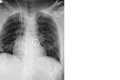 Two images in the same patient, with acquisition separated by several
minutes. (A) Bedside frontal chest radiograph image of the chest and abdomen
centered on the diaphragm to better visualize both markers on the intra-aortic
balloon pump catheter placed via a femoral approach. The caudal marker (white
dashed circle) is visible in the abdominal aorta, projecting over the L4
vertebral body. The position of this caudal marker suggests a low-lying
catheter. (B) Interestingly, the frontal chest radiograph demonstrates how
motion at time of image exposure in A can completely obscure the more cranial
marker (white solid circle). As shown, it lies below the level of the carina
(lower than expected) and accounts for the low-lying caudal marker observed in
A.