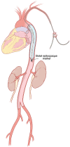 Diagram of axillary-approach catheter with the distal balloon marker
projecting over the mid aorta. If a single-marker catheter is employed by this
approach, the balloon positioning cannot be verified on a radiograph. (Used with
permission of Mayo Foundation for Medical Education and Research, all rights
reserved.)