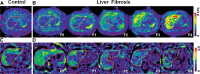 Representative three-dimensional MR elastography images in healthy
controls and participants with chronic hepatitis B or C (liver outlined with
dotted line). (A) Liver shear stiffness (SS) map in controls. (B) Liver SS
maps in patients with liver fibrosis (LF) from stages F0 to F4. (C) Damping
ratio (DR) map in controls. (D) DR maps in patients with LF from stages F0
to F4.