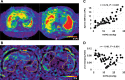 Representative three-dimensional (3D) MR elastography images (liver
and spleen outlined by dotted line) and scatterplots of portal pressure with
3D MR elastography–derived parameters. Maps of (A) shear stiffness
and (B) damping ratio (DR) in patients with portal hypertension.
Scatterplots of (C) hepatic venous pressure gradient (HVPG) with spleen
stiffness and (D) HVPG with liver DR. Scatterplots of 3D MR
elastography–derived parameters with portal vein pressure are shown
in Figure E4 (online).
