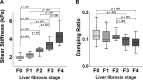 Boxplots show liver shear stiffness (SS) and damping ratio (DR)
determinations in participants with liver fibrosis (LF), assessed with
three-dimensional MR elastography. The lower and upper borders of boxes
correspond to the first and third quartiles (the 25th and 75th percentiles).
The midline of boxes indicate medians. The lower and upper whiskers
correspond to the 5th and 95th percentiles, respectively. Dots beyond the
end of the whiskers indicate outliers. (A) SS increased according to LF
stage (all P < .001; adjusted α = .005). (B) DR was consistent
across stages F0–F2, with declines at stages F3 and F4 (F0 vs F3 [P =
.002], F0 vs F4 [P < .001], F2 vs F4 [P < .001], and F2 vs F3
[P = .003]; adjusted α = .005).