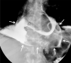 Frontal images from an esophagogram performed with water-soluble contrast material after surgical drainage of the pericardium and subsequent placement of an esophageal stent (S) across the esophagojejunostomy. (a) Early image in the study demonstrates persistent extraluminal contrast (dashed arrows) outside the alimentary tract, coursing toward midline. The loculated extraluminal collection depicted in Figure 2 remains and is again seen (*). (b) More delayed image from the study demonstrates oral contrast filling the pericardial space (thin arrows), confirming the presence of a persistent esophagopericardial fistula. Bilateral surgical drains are also present.