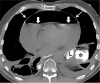 Axial CT image of the chest without intravenous contrast but with oral contrast demonstrates an air-fluid level (thick arrows) within the pericardial sac (thin arrows), confirming the large hydropneumopericardium. Oral contrast is seen in the lumen of the visualized alimentary tract (L) as well as a loculated extraluminal collection (*), consistent with a chronic anastomotic leak. Bilateral small pleural effusions are also present, left larger than right.