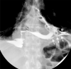 Frontal images from an esophagogram performed with water-soluble contrast material after surgical drainage of the pericardium and subsequent placement of an esophageal stent (S) across the esophagojejunostomy. (a) Early image in the study demonstrates persistent extraluminal contrast (dashed arrows) outside the alimentary tract, coursing toward midline. The loculated extraluminal collection depicted in Figure 2 remains and is again seen (*). (b) More delayed image from the study demonstrates oral contrast filling the pericardial space (thin arrows), confirming the presence of a persistent esophagopericardial fistula. Bilateral surgical drains are also present.