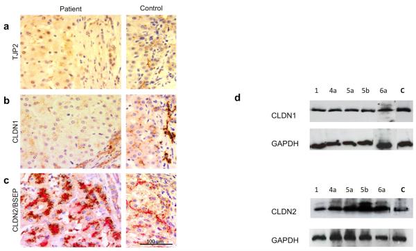 Mutations in TJP2 cause progressive cholestatic liver disease - PMC