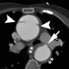 Limited intimal tears (LITs) and intramural hematoma (IMH). Axial
contrast-enhanced image from CT angiography demonstrates LIT with focal bulge in
the ascending thoracic aorta (arrowheads), as well as LIT (arrow) and IMH
(**) in the descending thoracic aorta. IMH was hyperattenuated on
noncontrast imaging (not shown).