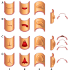 Drawings of limited aortic intimal tear configurations. (A) Linear, (B)
L-shaped, (C) T-shaped, and (D) stellate tear configurations within endoluminal
(1–2) and external surface (3–4) views of the aorta. Linear tear
represented a tear in a single plane or orientation. L-shaped tear reflected a
linear tear with an additional tear plane oriented at the end and perpendicular
to the linear tear. T-shaped tear had an additional tear plane oriented at the
mid segment and perpendicular to a linear tear plane. Stellate tear represented
a star-shaped configuration.