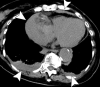 Ancillary findings of hemopericardium (mean attenuation, 46 HU) and
bilateral hemothorax (mean attenuation, 28 HU) (arrowheads) on axial noncontrast
CT image in a patient with limited intimal tear of the ascending thoracic
aorta.
