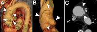 L-shaped limited intimal tear (LIT). (A) Blood-pool inversion
volume-rendered endoluminal CT image shows type A LIT with L-shaped
configuration in the ascending thoracic aorta (arrowheads). (B) Volume-rendered
CT image of external surface of ascending aorta shows the tear (arrowheads). (C)
Axial contrast-enhanced CT angiographic image demonstrates undermined edges of
the tear (arrowheads), with focal outpouching of the remaining aortic wall
(**).