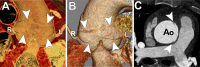 Linear-shaped limited intimal tear (LIT). (A) Blood-pool inversion
volume-rendered endoluminal CT image shows ovoid, linear type A LIT in the
aortic root (arrowheads). Note proximity to the left (L) and right (R) coronary
arteries. (B) Volume-rendered CT image of external surface of the aortic root
demonstrates linear defect (arrowheads) spanning the distance between the left
(L) and right (R) coronary arteries. (C) Axial contrast-enhanced CT angiographic
image of the ascending thoracic aorta (Ao) shows focal linear filling defects
(arrowheads) representing the undermined edges of the tear.