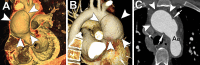 Stellate-shaped limited intimal tear (LIT). (A) Blood-pool inversion
volume-rendered endoluminal CT image shows type A LIT with stellate tear vector,
resulting in large ovoid defect (arrowheads). (B) Volume-rendered CT image of
external surface shows large ovoid bulge (arrowheads) representing the remaining
media and adventitia within the LIT. (C) Axial contrast-enhanced CT angiographic
image demonstrates undermined edges (arrows) at the LIT in the proximal
transverse aorta (Ao). Large bulge anteriorly between the edges represents the
residual aortic wall (arrowheads).