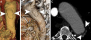 Limited intimal tear (LIT) of descending thoracic aorta with intramural
hematoma. (A) Blood-pool inversion volume-rendered endoluminal CT image shows
type B LIT (arrowheads) of the proximal descending thoracic aorta. (B)
Volume-rendered CT image of external surface shows the tear (arrowheads). (C)
Axial contrast-enhanced CT angiographic image of type B LIT (arrowheads) and
intramural hematoma (**).