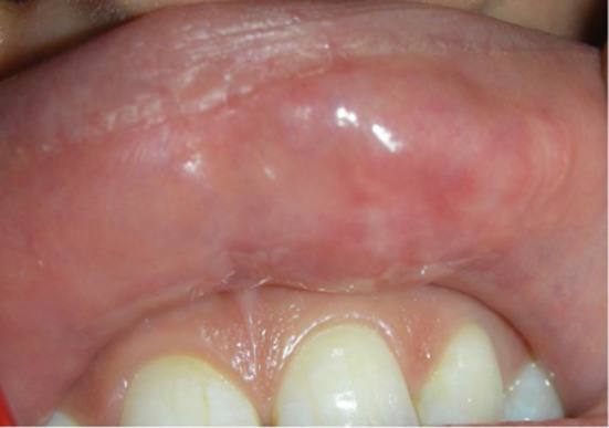 Calibre Persistent Labial Artery: Clinical Features and ...