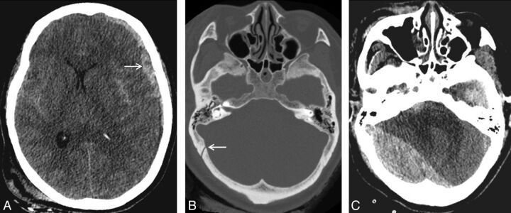 Calvarial Fracture Patterns on CT Imaging Predict Risk of a Delayed ...