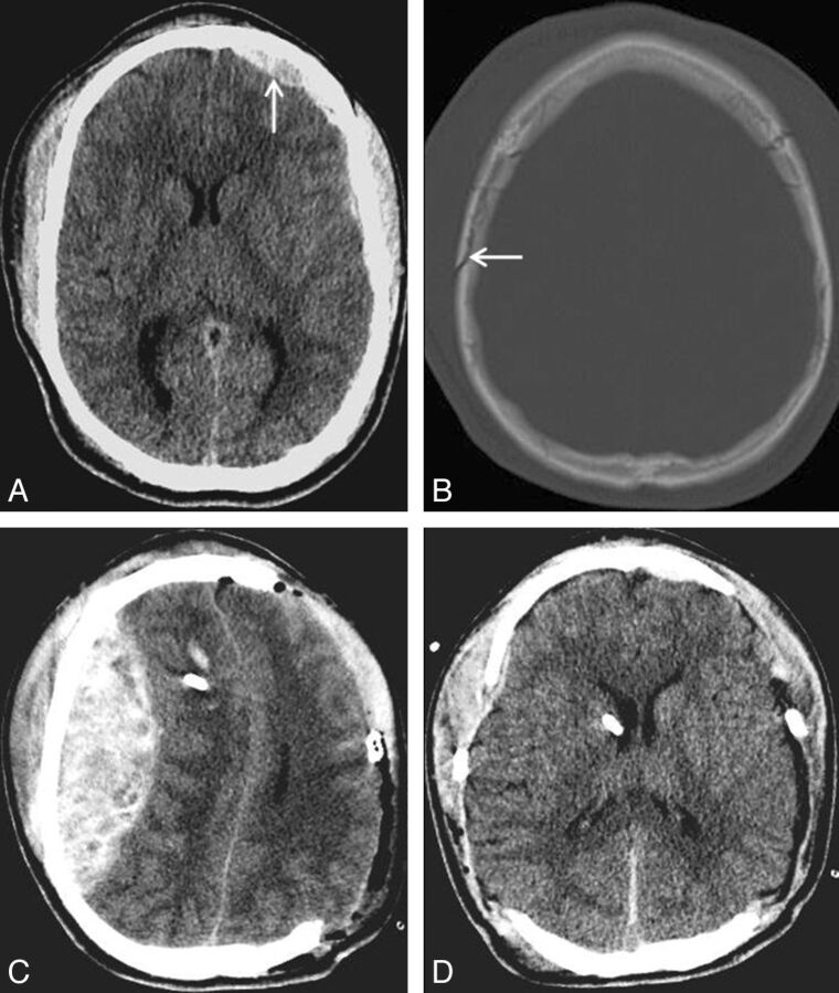 Calvarial Fracture Patterns on CT Imaging Predict Risk of a Delayed ...