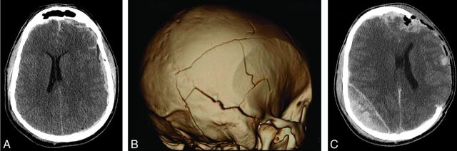 Calvarial Fracture Patterns on CT Imaging Predict Risk of a Delayed ...