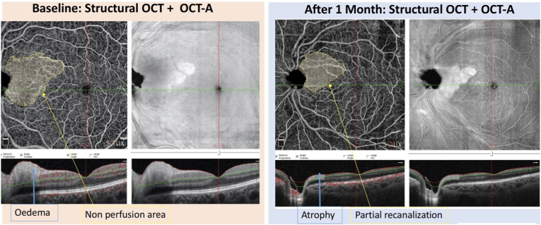 A case of cilioretinal artery occlusion: Diagnostic procedures - PMC