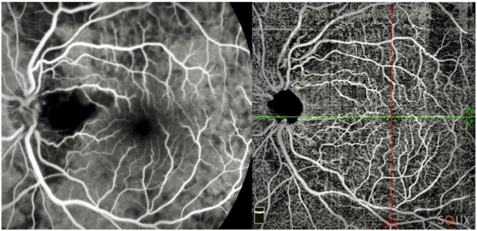 A case of cilioretinal artery occlusion: Diagnostic procedures - PMC