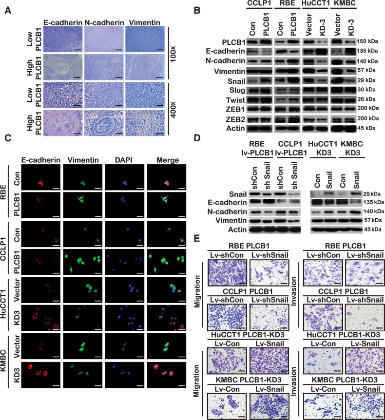 Figure 4. Snail is essential for PLCB1-mediated EMT in CCA. A, Typical images of IHC staining in CCA tissues presented expression of PLCB1 was associated with the EMT-related biomarkers. Scale bars, 100× = 400 μm; 400× = 100 μm. B, Western blot showed the expression of EMT-associated proteins and transcription factors. C, Typical IF images of the expression of E-cadherin and vimentin for indicated CCA cell lines. Scale bars, 400× = 100 μm. D, Western blot presented that snail overexpression and knockdown restored the levels of the EMT-related markers and was affected by PLCB1 in indicated CCA cell lines. Sh Con, snail knockdown negative control. Sh Snail, snail knockdown. Con, snail overexpression negative control. Snail, snail overexpression. E, Typical images of migration and invasion assays demonstrated that upregulated and downregulated snail restored the number of the RBE-PLCB1 group and the HuCCT1-PLCB1-KD3 group. Scale bars, 100× = 400 μm. All experiments were implemented three times, and data are presented as mean ± SD.