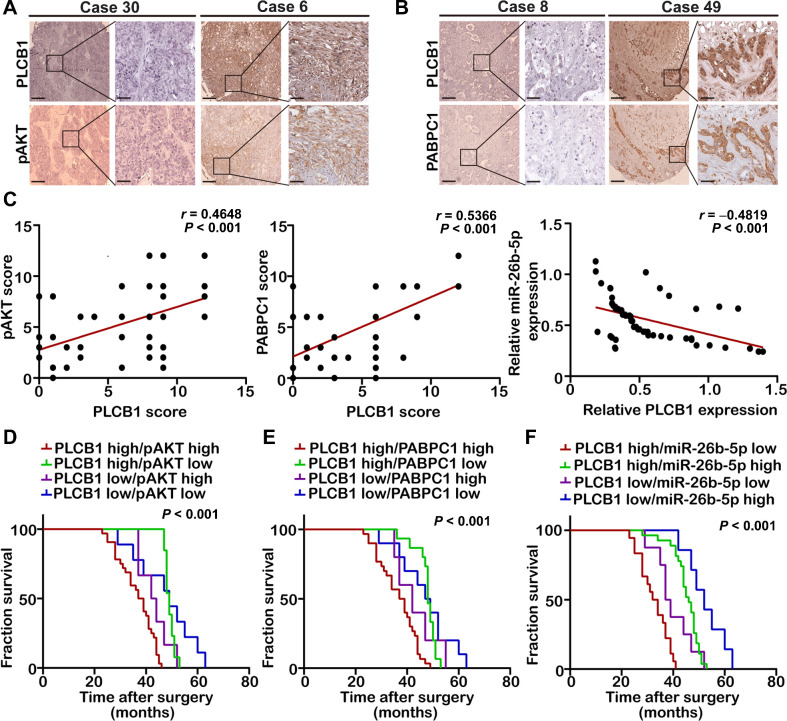 Figure 8. Analysis of clinical prognosis in combination of PLCB1 with PABPC1, pAKT, or miR-26b-5p. A, Typical images of IHC staining analysis of PLCB1 and pAKT expression in 60 CCA human tissues. Scale bars, 100× = 400 μm; 400× = 100 μm. B, Typical images of IHC staining analysis of PLCB1 and PABPC1 expression in 60 CCA human tissues. Scale bars, 100× = 400 μm; 400× = 100 μm. C, Correlation analysis indicated that PLCB1 was positively correlated with pAKT or PABPC1 and was an inverse correlation with miR-26b-5p. Pearson correlation analysis was used. D, Kaplan–Meier analysis of fraction survival in patients with variable expressions of PLCB1 and pAKT. E, Kaplan–Meier analysis of fraction survival in patients with variable expressions of PLCB1 and PABPC1. F, Kaplan–Meier analysis of fraction survival in patients with variable expressions of PLCB1 and miR-26b-5p. All experiments were implemented three times, and data are presented as mean ± SD.