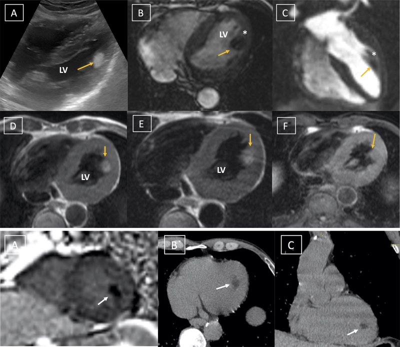 TTE/SSFP images show echogenic oval mass attached to LV papillary muscle. Figure 2 CT/LGE images show mass with fat attenuation suggesting cardiac lipoma