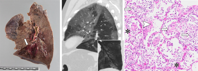 (a) Radiologic-pathologic correlation in patient 1, a 67-year-old woman. Gross pathology findings show interlobular septal edema, congestion, thickened bronchial walls (arrow), and consolidation (arrowhead). The corresponding CT in sagittal plane discloses bronchial wall thickening (arrow) and dystelectasis in the posterior parts of the lower lobes (arrowhead). Photomicrographs show bronchopneumonia in the left lower lobe (top left and right), thickened bronchial walls (bottom left), and microthrombosis (bottom right, immunohistochemistry for fibrin polyclonal antibody [A0080; Dako]; other photomicrographs, hematoxylin-eosin [H&E] stain, magnification not available [N/A]). (b) Radiologic-pathologic correlation in patient 2, a 66-year-old man. Gross findings document interlobular septal edema and segmental hemorrhage in the anterobasal segment of the left lower lobe (arrow), while CT scan shows peripherally pronounced ground-glass opacity (GGO) in the left lower lobe. Inserted minimum intensity projection reveals some focal bronchial dilatation in association to GGOs. Photomicrograph reveals hyaline membranes as remnants of acute exudative (arrowhead) and intra-alveolar fibroblastic proliferations as signs of proliferative diffuse alveolar damage (DAD) (arrows) . Furthermore, capillaries show extensive congestion (*). (H&E stain, magnification N/A.) (c) Radiologic-pathologic correlation in patient 3, a 73-year-old man. Gross findings show interstitial edema, congestion, and chronic pulmonary embolism in the left upper lobe that was not disclosed by imaging due to unenhanced acquisition (insert). CT scan discloses extensive GGO in transition to consolidation in the left lower lobe (arrow) as well as lingula. Photomicrograph reveals hyaline membranes as a correlate of acute exudative DAD predominantly in the left lower lobe (arrow). (H&E stain, magnification N/A.)