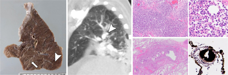 (a) Radiologic-pathologic correlation in patient 1, a 67-year-old woman. Gross pathology findings show interlobular septal edema, congestion, thickened bronchial walls (arrow), and consolidation (arrowhead). The corresponding CT in sagittal plane discloses bronchial wall thickening (arrow) and dystelectasis in the posterior parts of the lower lobes (arrowhead). Photomicrographs show bronchopneumonia in the left lower lobe (top left and right), thickened bronchial walls (bottom left), and microthrombosis (bottom right, immunohistochemistry for fibrin polyclonal antibody [A0080; Dako]; other photomicrographs, hematoxylin-eosin [H&E] stain, magnification not available [N/A]). (b) Radiologic-pathologic correlation in patient 2, a 66-year-old man. Gross findings document interlobular septal edema and segmental hemorrhage in the anterobasal segment of the left lower lobe (arrow), while CT scan shows peripherally pronounced ground-glass opacity (GGO) in the left lower lobe. Inserted minimum intensity projection reveals some focal bronchial dilatation in association to GGOs. Photomicrograph reveals hyaline membranes as remnants of acute exudative (arrowhead) and intra-alveolar fibroblastic proliferations as signs of proliferative diffuse alveolar damage (DAD) (arrows) . Furthermore, capillaries show extensive congestion (*). (H&E stain, magnification N/A.) (c) Radiologic-pathologic correlation in patient 3, a 73-year-old man. Gross findings show interstitial edema, congestion, and chronic pulmonary embolism in the left upper lobe that was not disclosed by imaging due to unenhanced acquisition (insert). CT scan discloses extensive GGO in transition to consolidation in the left lower lobe (arrow) as well as lingula. Photomicrograph reveals hyaline membranes as a correlate of acute exudative DAD predominantly in the left lower lobe (arrow). (H&E stain, magnification N/A.)