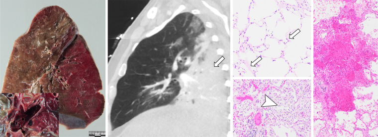 (a) Radiologic-pathologic correlation in patient 4, an 81-year-old woman. Gross specimen shows congestion, interlobular septal edema, and emphysema (arrow). CT scan reveals consolidation (arrow) in the posterior parts of the left lower lobe and crazy paving (arrowhead) in the apical upper lobe. Photomicrograph reveals both hyaline membranes as correlates of acute exudative (arrowheads) and intra-alveolar fibrohistiocytic proliferates as signs of proliferative diffuse alveolar damage (DAD) (arrows). (Hematoxylin-eosin [H&E] stain, magnification not available [N/A].) (b) Radiologic-pathologic correlation in patient 6, a 71-year-old man. Gross specimen shows congestion and severe consolidation (arrow). CT scan shows obstruction and consolidation in the posterior parts of the upper and lower right lobe (arrow). Photomicrograph shows extensive bronchopneumonia, dilated capillaries (arrows), vasculitis (insert at bottom right), and microthrombosis (not shown). Next-generation sequencing identified bacterial species such as Staphylococcus aureus and several strains of streptococcal species. (H&E stain, magnification N/A.) (c) Radiologic-pathologic correlation in patient 9, a 58-year-old man. Gross specimen shows congestion, interlobular septal edema, and multiple thromboembolisms (insert at lower left). CT scan reveals subtotal consolidation of the left lower lobe (arrow) and bilateral pulmonary embolisms (not shown). Photomicrograph shows hyaline membranes as correlates of acute exudative (arrows) and fibroblastic proliferations as signs of proliferative DAD (arrowhead), as well as alveolar hemorrhage (far right). (H&E stain, magnification N/A.)