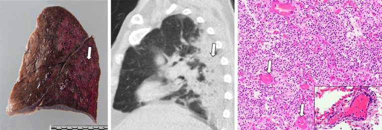 (a) Radiologic-pathologic correlation in patient 4, an 81-year-old woman. Gross specimen shows congestion, interlobular septal edema, and emphysema (arrow). CT scan reveals consolidation (arrow) in the posterior parts of the left lower lobe and crazy paving (arrowhead) in the apical upper lobe. Photomicrograph reveals both hyaline membranes as correlates of acute exudative (arrowheads) and intra-alveolar fibrohistiocytic proliferates as signs of proliferative diffuse alveolar damage (DAD) (arrows). (Hematoxylin-eosin [H&E] stain, magnification not available [N/A].) (b) Radiologic-pathologic correlation in patient 6, a 71-year-old man. Gross specimen shows congestion and severe consolidation (arrow). CT scan shows obstruction and consolidation in the posterior parts of the upper and lower right lobe (arrow). Photomicrograph shows extensive bronchopneumonia, dilated capillaries (arrows), vasculitis (insert at bottom right), and microthrombosis (not shown). Next-generation sequencing identified bacterial species such as Staphylococcus aureus and several strains of streptococcal species. (H&E stain, magnification N/A.) (c) Radiologic-pathologic correlation in patient 9, a 58-year-old man. Gross specimen shows congestion, interlobular septal edema, and multiple thromboembolisms (insert at lower left). CT scan reveals subtotal consolidation of the left lower lobe (arrow) and bilateral pulmonary embolisms (not shown). Photomicrograph shows hyaline membranes as correlates of acute exudative (arrows) and fibroblastic proliferations as signs of proliferative DAD (arrowhead), as well as alveolar hemorrhage (far right). (H&E stain, magnification N/A.)