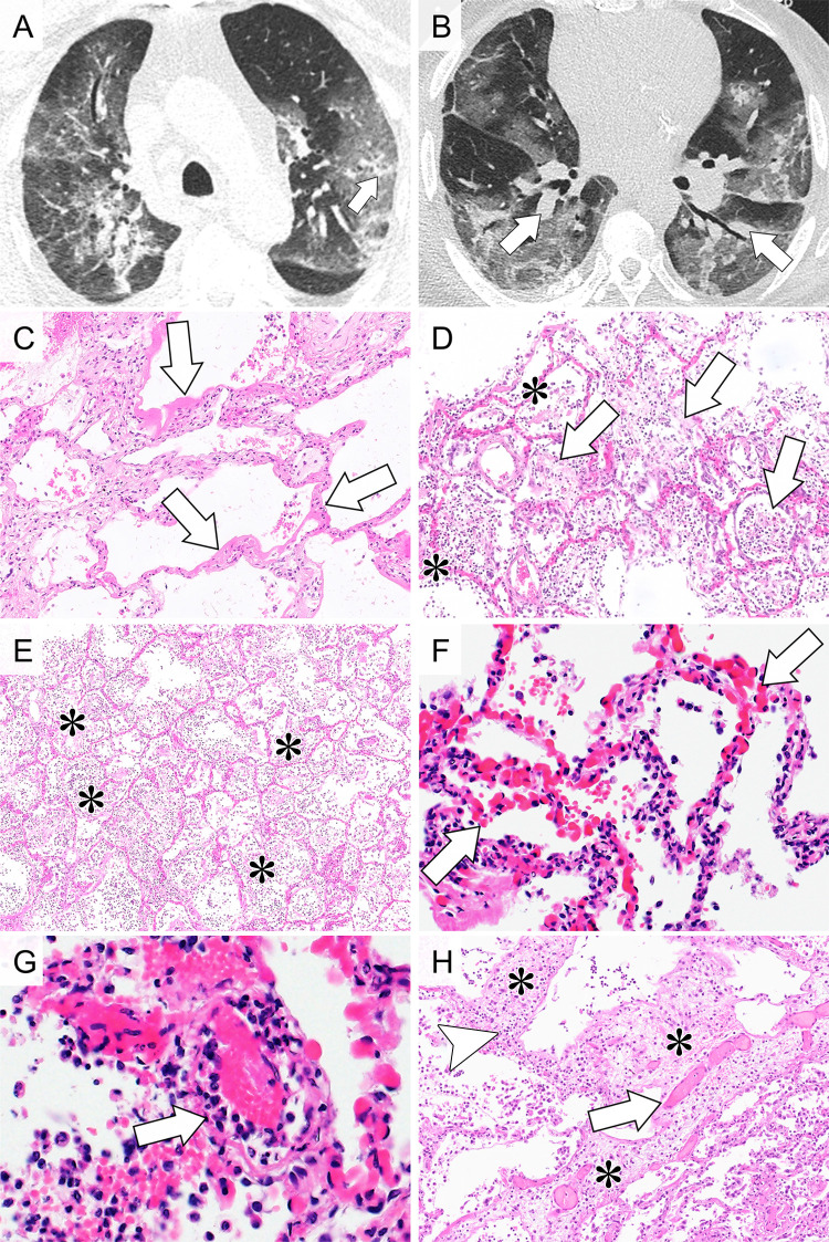 Overview of radiographic and histopathologic observations. A, Transverse CT image shows dilated peripheral focal pulmonary artery next to consolidation and ground-glass opacity marked with an arrow (vascular thickening). B, Transverse CT image shows dilated segmental arteries marked with arrows (pulmonary arterial enlargement). C, Photomicrograph shows diffuse alveolar damage, exudative phase. Hyaline membranes made up of fibrin cover surface of alveolae (arrows). There is only a sparse interstitial inflammatory infiltrate. (Hematoxylin-eosin [H&E] stain; original magnification, x100). D, Photomicrograph shows diffuse alveolar damage, proliferative phase. Within alveolae, there are fibrohistiocytic proliferations (arrows); hyaline membranes are already resorbed. Extensive capillary congestion is also found (*). (H&E stain; original magnification, x100). E, Photomicrograph shows severe acute bronchopneumonia with alveolae filled with aggregates of neutrophils and fibrin (*). There are no hyaline membranes covering alveolar walls. (H&E stain; original magnification, x50). F, Photomicrograph with higher magnification of alveolar walls shows massive capillary congestion. (H&E stain; original magnification, x200). G, Photomicrograph of small pulmonary artery shows inflammatory infiltrates primarily consisting of neutrophils infiltrating vessel walls (arrow). (H&E stain; original magnification, x400). H, Photomicrograph of interstitial edema. Lung parenchyma with massively widened interstitial spaces shows edema (*), dilated capillaries (arrow), and lymphohistiocytic inflammatory infiltrates (arrowhead) (H&E stain; original magnification, x100).