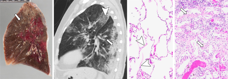 (a) Radiologic-pathologic correlation in patient 4, an 81-year-old woman. Gross specimen shows congestion, interlobular septal edema, and emphysema (arrow). CT scan reveals consolidation (arrow) in the posterior parts of the left lower lobe and crazy paving (arrowhead) in the apical upper lobe. Photomicrograph reveals both hyaline membranes as correlates of acute exudative (arrowheads) and intra-alveolar fibrohistiocytic proliferates as signs of proliferative diffuse alveolar damage (DAD) (arrows). (Hematoxylin-eosin [H&E] stain, magnification not available [N/A].) (b) Radiologic-pathologic correlation in patient 6, a 71-year-old man. Gross specimen shows congestion and severe consolidation (arrow). CT scan shows obstruction and consolidation in the posterior parts of the upper and lower right lobe (arrow). Photomicrograph shows extensive bronchopneumonia, dilated capillaries (arrows), vasculitis (insert at bottom right), and microthrombosis (not shown). Next-generation sequencing identified bacterial species such as Staphylococcus aureus and several strains of streptococcal species. (H&E stain, magnification N/A.) (c) Radiologic-pathologic correlation in patient 9, a 58-year-old man. Gross specimen shows congestion, interlobular septal edema, and multiple thromboembolisms (insert at lower left). CT scan reveals subtotal consolidation of the left lower lobe (arrow) and bilateral pulmonary embolisms (not shown). Photomicrograph shows hyaline membranes as correlates of acute exudative (arrows) and fibroblastic proliferations as signs of proliferative DAD (arrowhead), as well as alveolar hemorrhage (far right). (H&E stain, magnification N/A.)