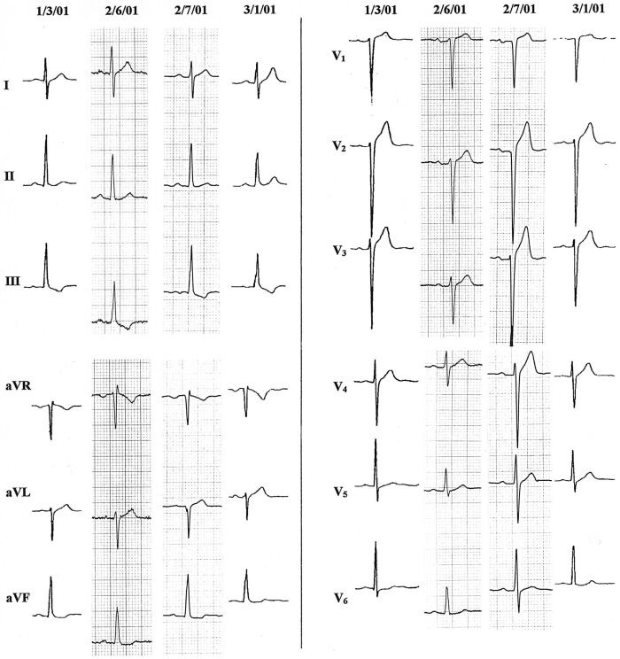 Left Septal Fascicular Block: Myth Or Reality? - PMC