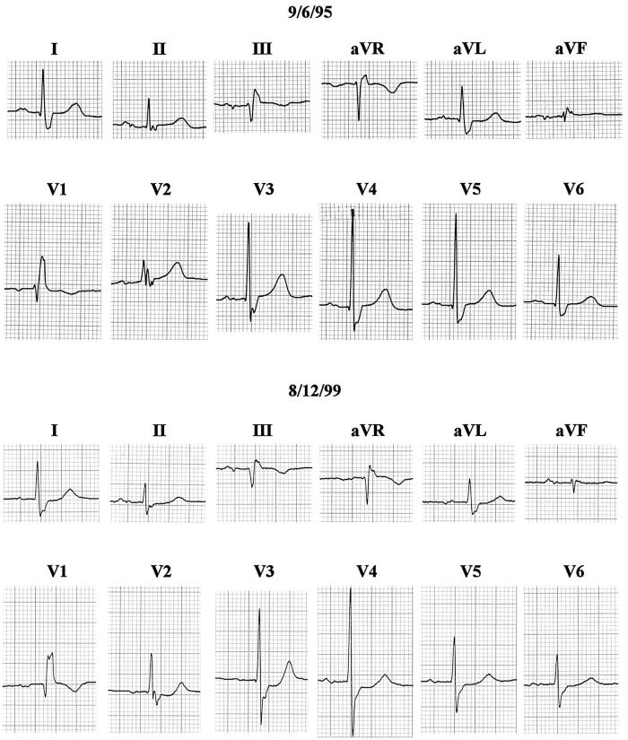 Left Septal Fascicular Block: Myth Or Reality? - PMC