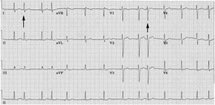 Left Septal Fascicular Block: Myth Or Reality? - PMC