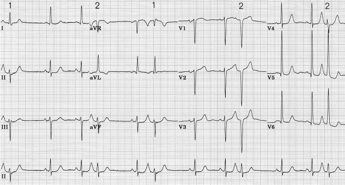 Left Septal Fascicular Block: Myth Or Reality? - PMC