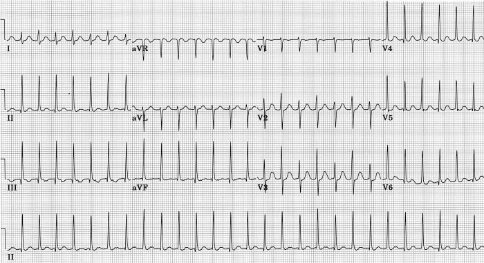 Left Septal Fascicular Block: Myth Or Reality? - PMC