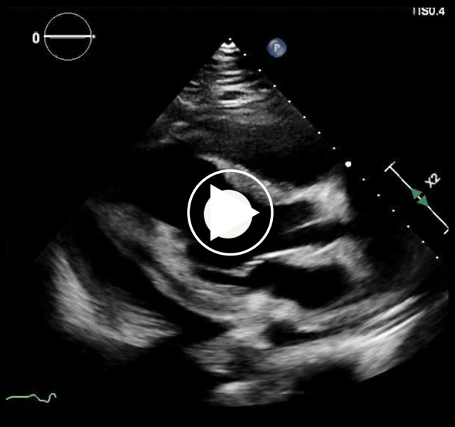 Cardiac Tamponade as Initial Presentation of Systemic Lupus ...