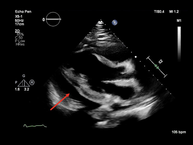 Cardiac Tamponade as Initial Presentation of Systemic Lupus ...