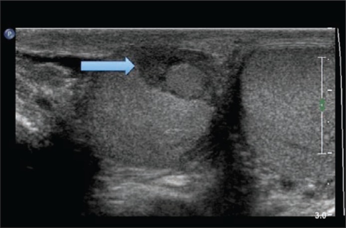 Intratesticular hematoma after blunt scrotal trauma: a case series and ...