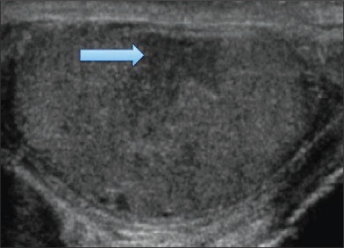 Intratesticular hematoma after blunt scrotal trauma: a case series and ...